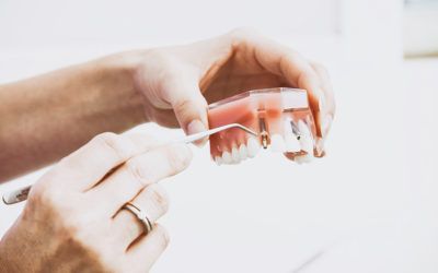 Implantes Dentales sin Cirugía