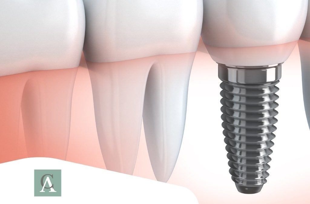 ¿Qué son Implantes Dentales?
