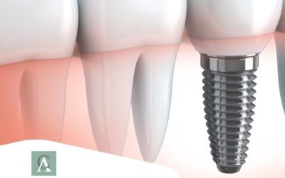 ¿Qué son Implantes Dentales?