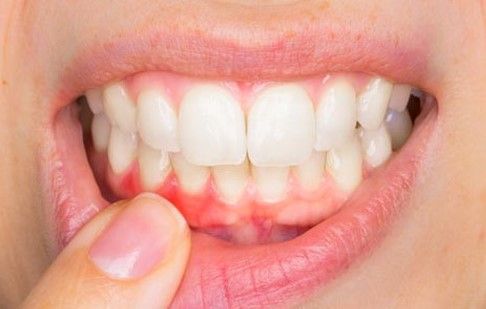 Enfermedad Periodontal y su relación con otras enfermedades