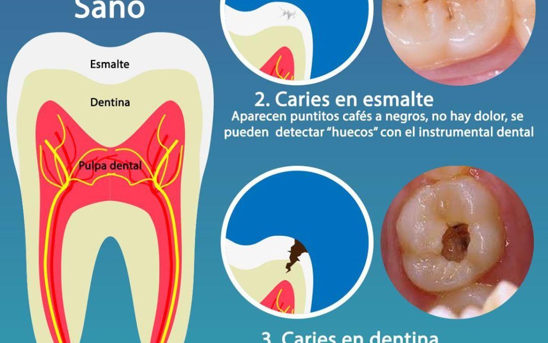 Todo lo que debes saber sobre la caries dental